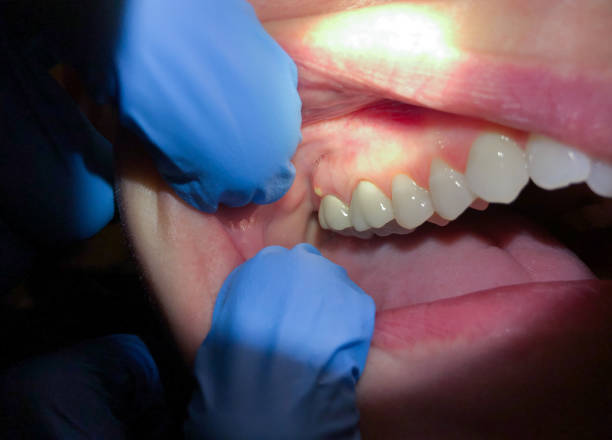 Best Emergency Denture Repair in Loyola, CA